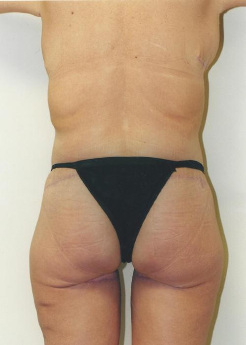 Body Lift Patient Photo - Case 85 - after view