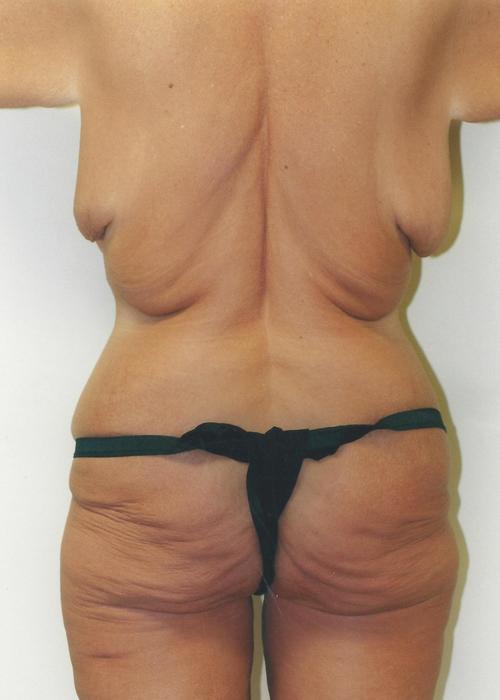 Body Lift Patient Photo - Case 85 - before view-