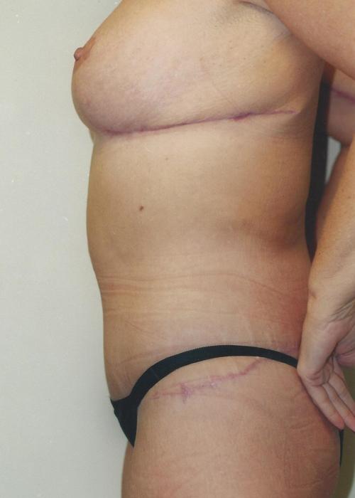 Body Lift Patient Photo - Case 85 - after view-1