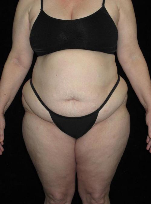 Body Lift Patient Photo - Case 76 - before view-