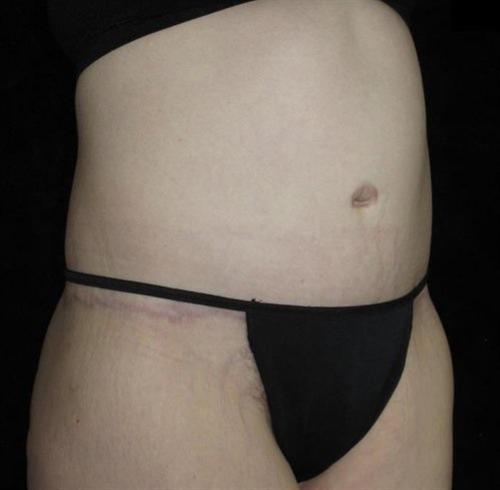 Body Lift Patient Photo - Case 79 - after view