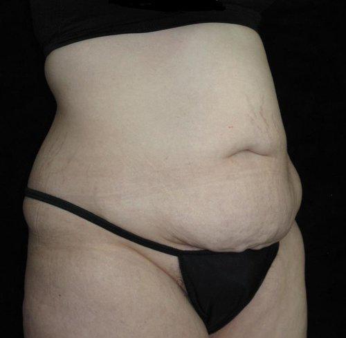 Body Lift Patient Photo - Case 79 - before view-