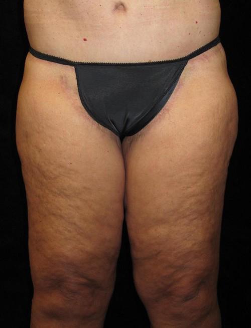 Body Lift Patient Photo - Case 67 - after view-2