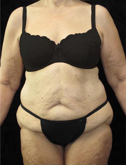 Body Lift Patient Photo - Case 67 - before view-