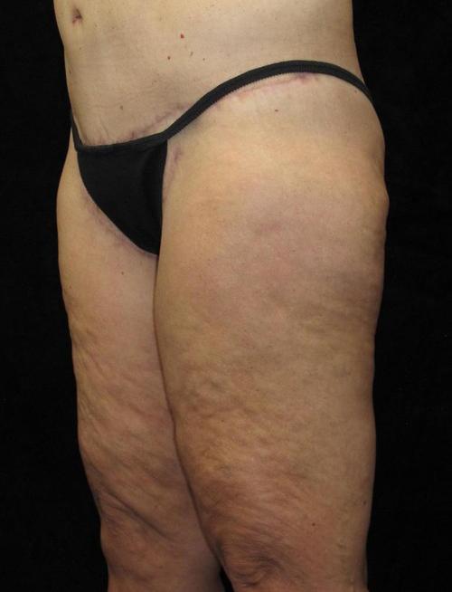 Body Lift Patient Photo - Case 67 - after view-3