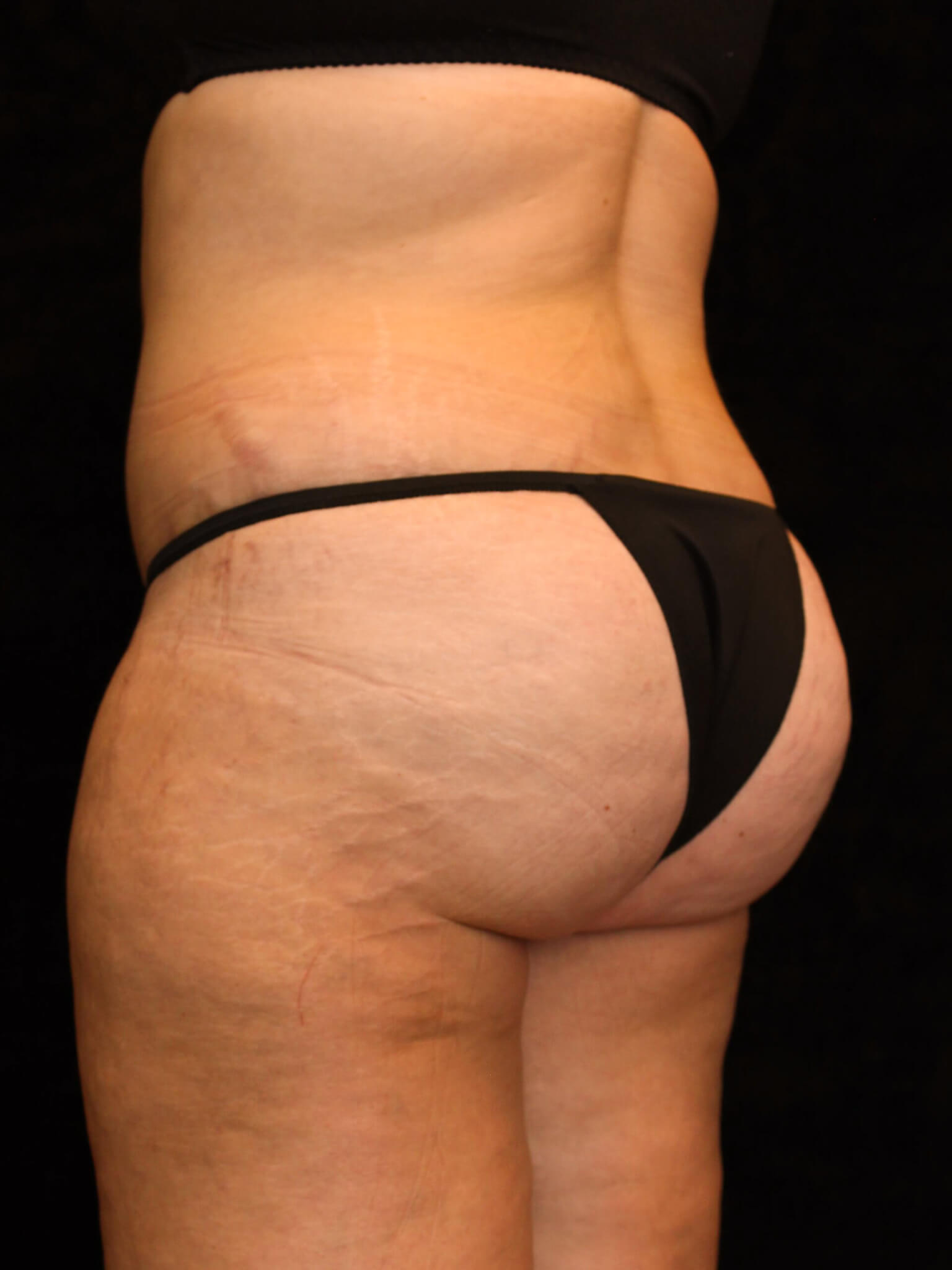 Mommy Makeover Patient Photo - Case 15898 - after view-3