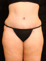 Mommy Makeover - Case 15898 - After