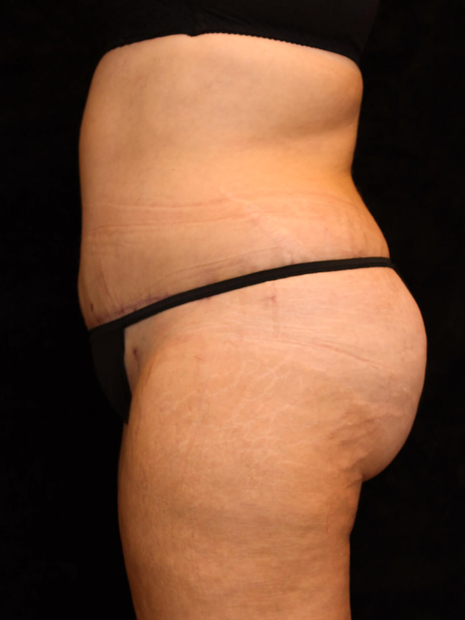 Mommy Makeover Patient Photo - Case 15898 - after view-2