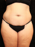 Mommy Makeover - Case 15898 - Before