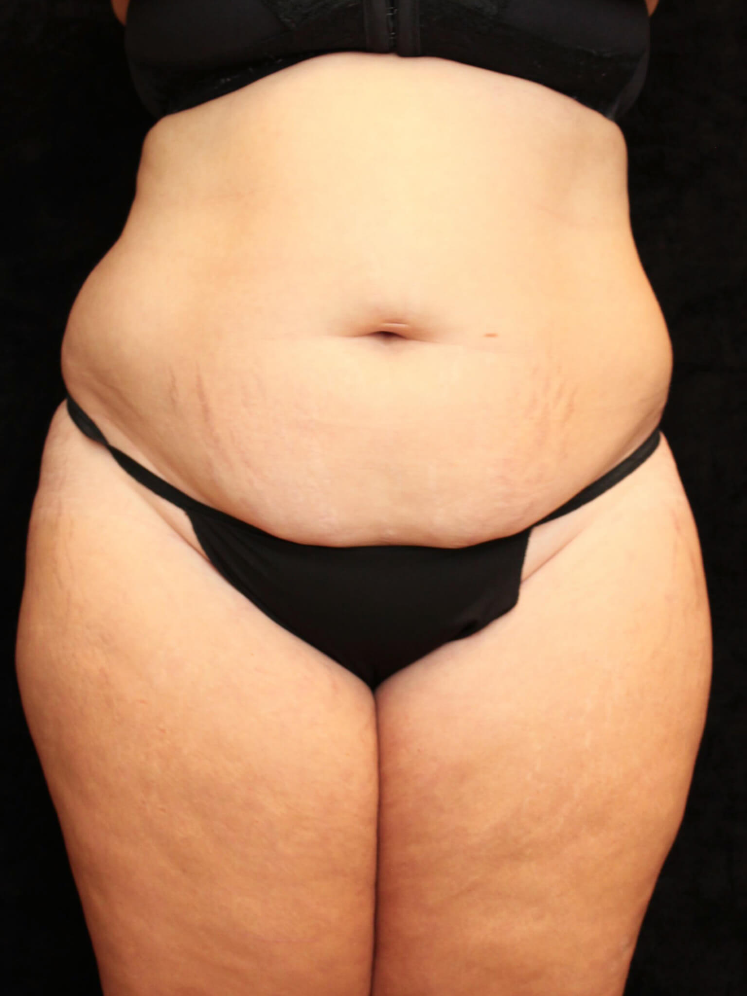 Mommy Makeover Patient Photo - Case 15898 - before view-