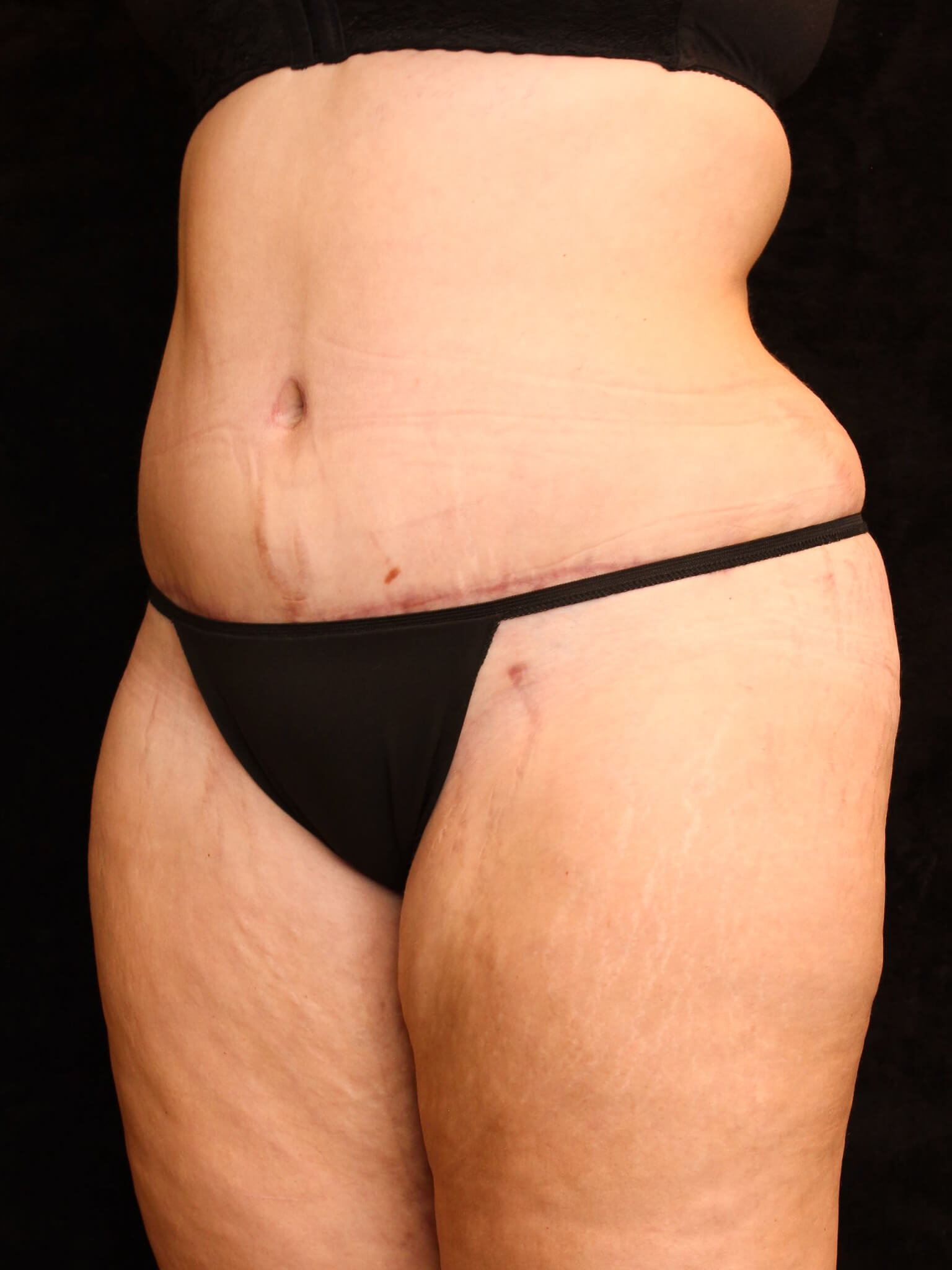 Mommy Makeover Patient Photo - Case 15898 - after view-1