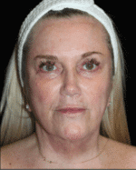 Facelift - Case 15932 - After