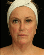 Facelift - Case 15932 - Before