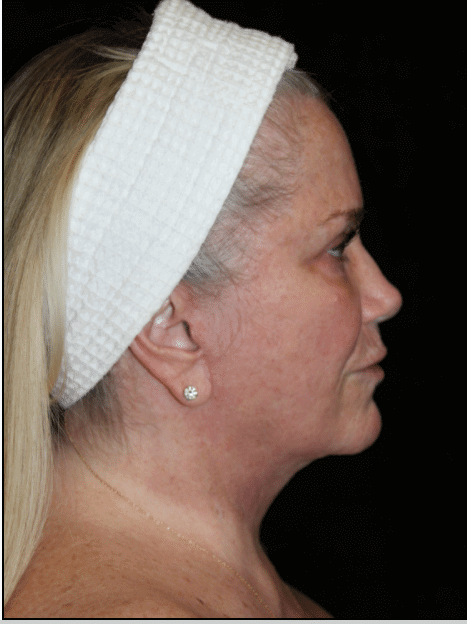 Facelift Patient Photo - Case 15932 - after view-2