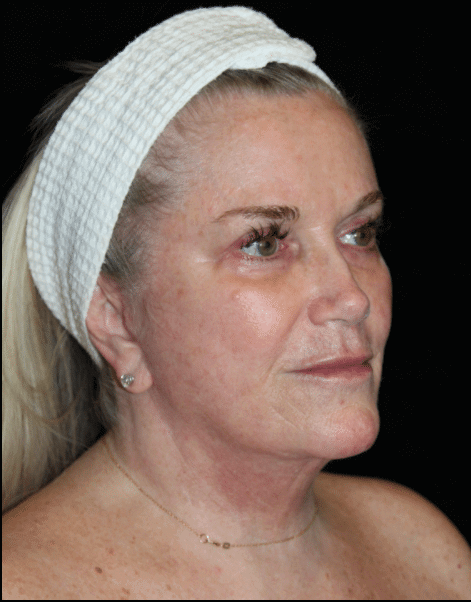 Facelift Patient Photo - Case 15932 - after view-1
