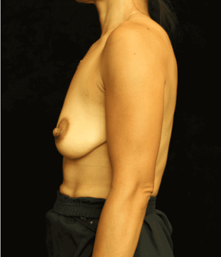 Breast Asymmetry before and after results - Nashville patient - before view 3