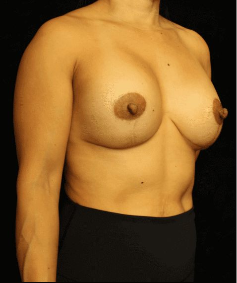 Breast Asymmetry before and after results - Nashville patient - after view 2