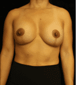 Breast Asymmetry - Case 15270 - After