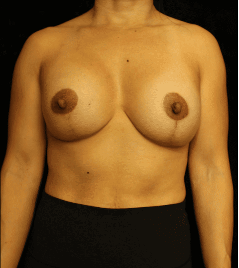 Breast Asymmetry before and after results - Nashville patient - after