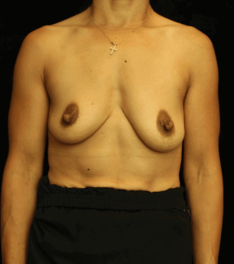 Breast Asymmetry before and after results - Nashville patient - before