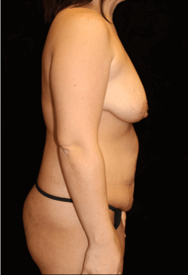 Breast lift with Augmentation Patient Photo - Case #15530 - before view-2