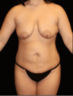 Breast lift with Augmentation - Case #15530 - Before