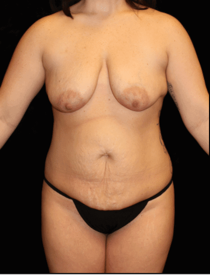 Breast lift with Augmentation Patient Photo - Case #15530 - before view-0