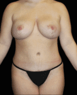 Breast lift with Augmentation - Case #15530 - After