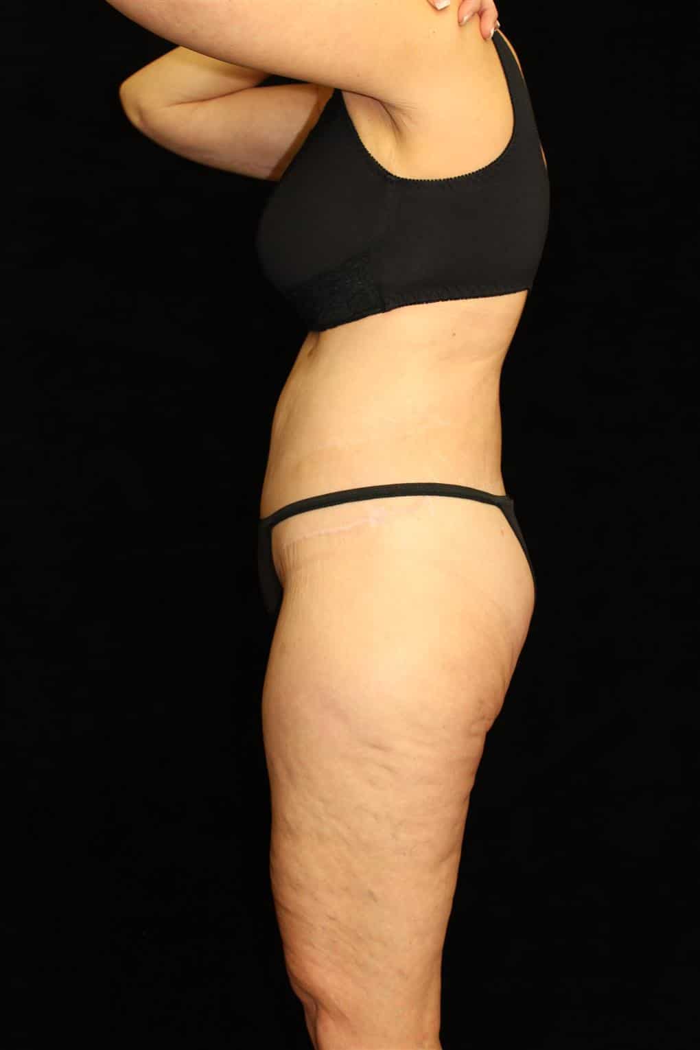 Body Lift Patient Photo - Case 12997 - after view-1