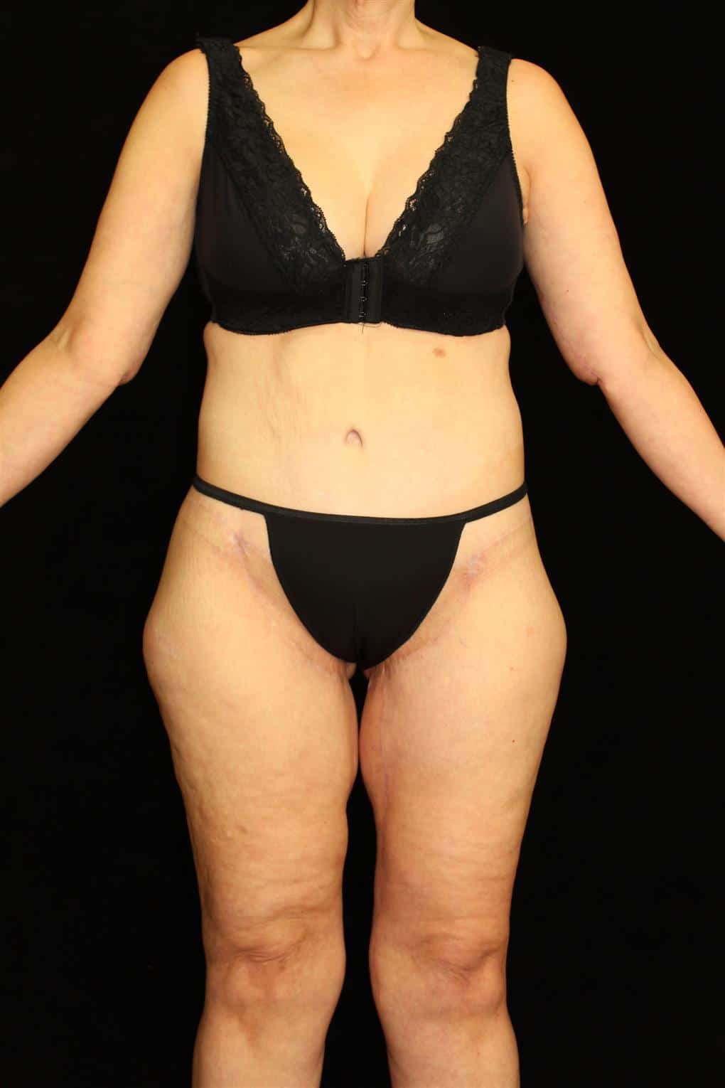 Body Lift Patient Photo - Case 12997 - after view