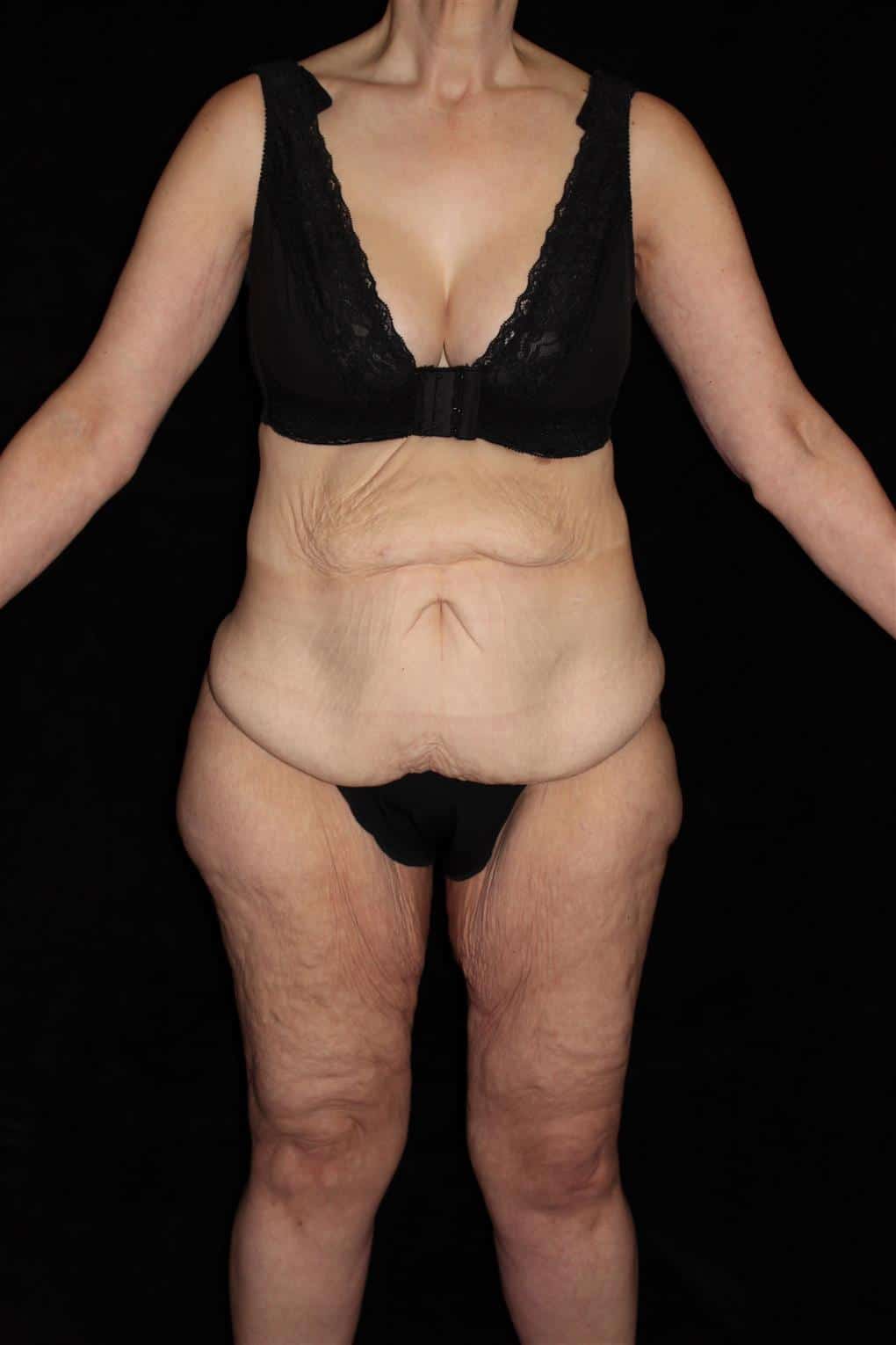 Body Lift Patient Photo - Case 12997 - before view-