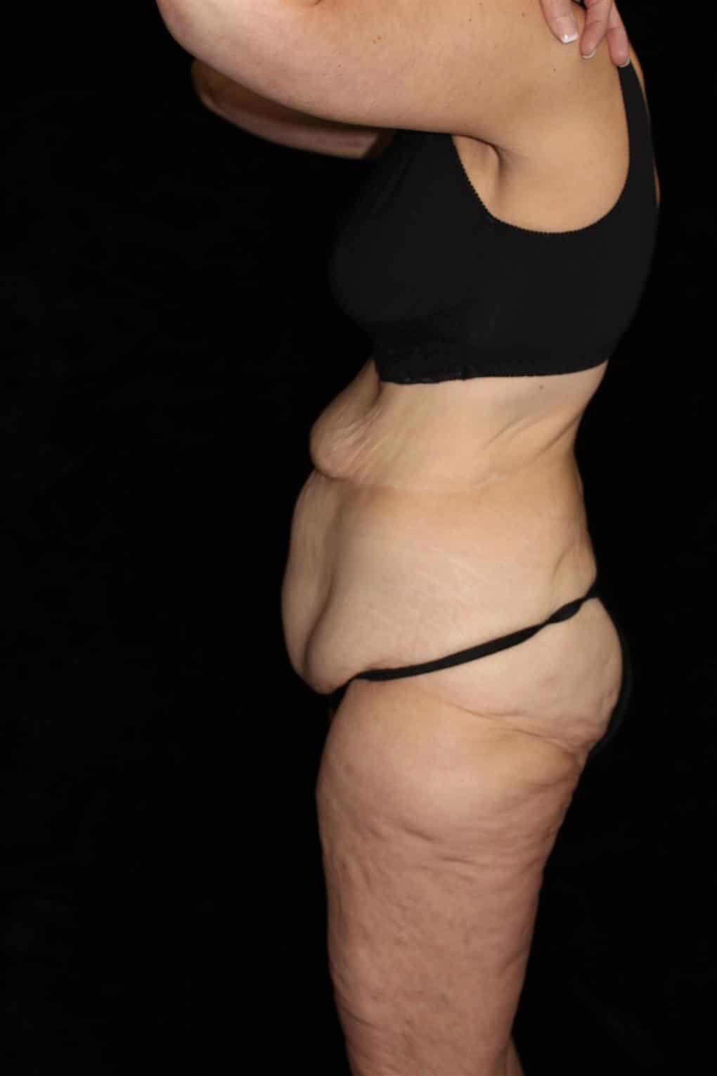Body Lift Patient Photo - Case 12997 - before view-1