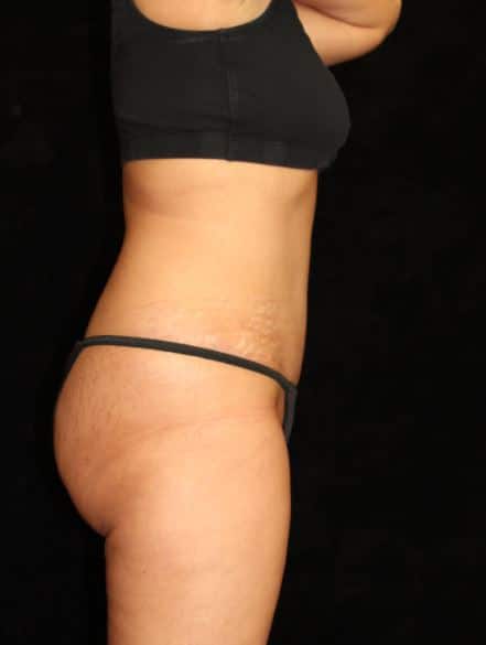 Liposuction Patient Photo - Case 14823 - after view-2