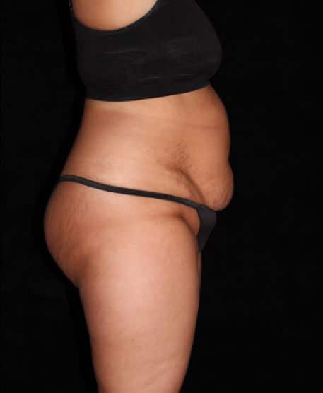 Liposuction Patient Photo - Case 14823 - before view-2