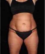 Liposuction - Case 14823 - Before