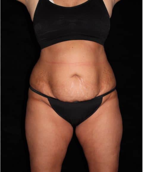 Liposuction Patient Photo - Case 14823 - before view-