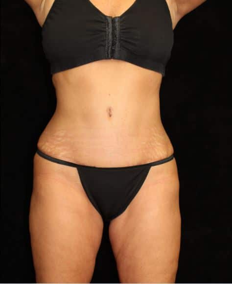 Liposuction Patient Photo - Case 14823 - after view