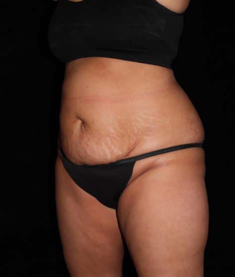 Liposuction Patient Photo - Case 14823 - before view-1