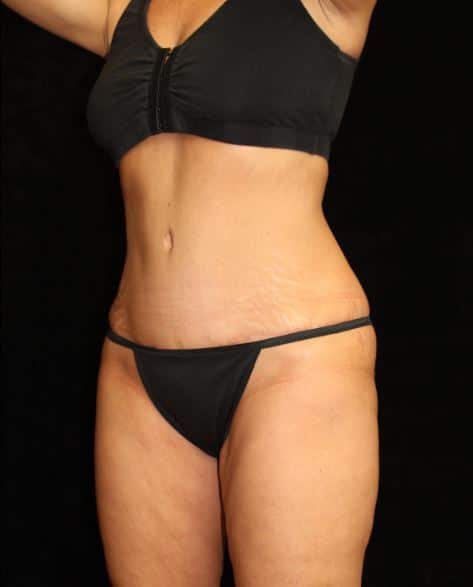 Liposuction Patient Photo - Case 14823 - after view-1