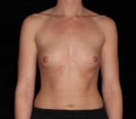 Breast Augmentation before and after results - Nashville patient - Before