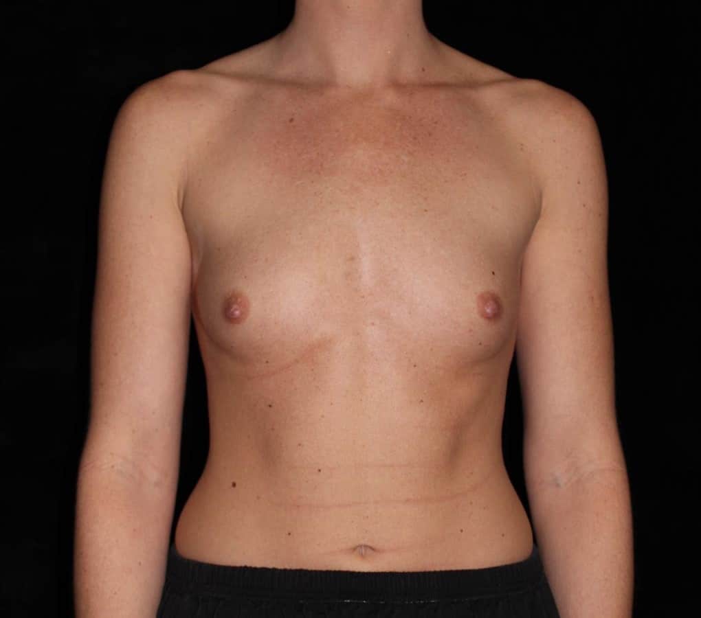 Breast Augmentation Patient Photo - Case 13672 - before view-