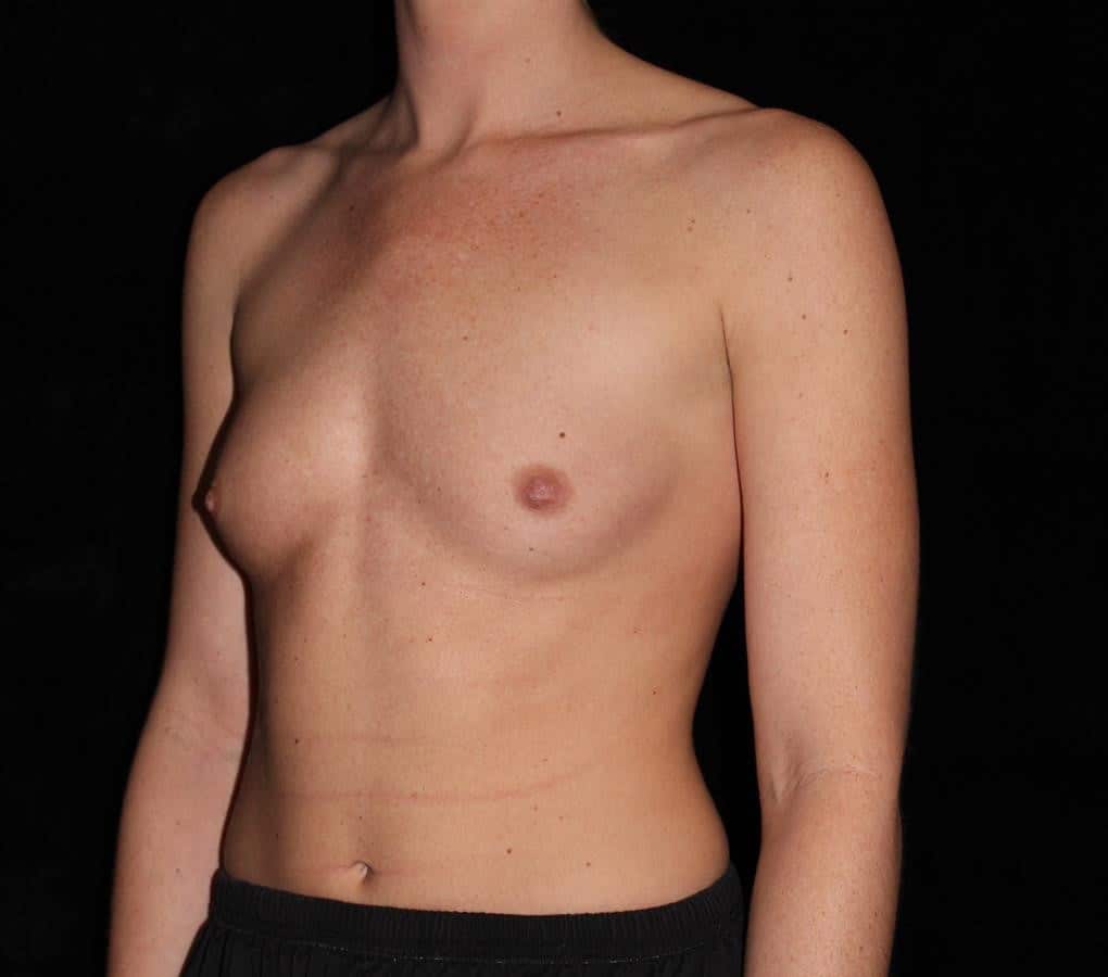 Breast Augmentation Patient Photo - Case 13672 - before view-1