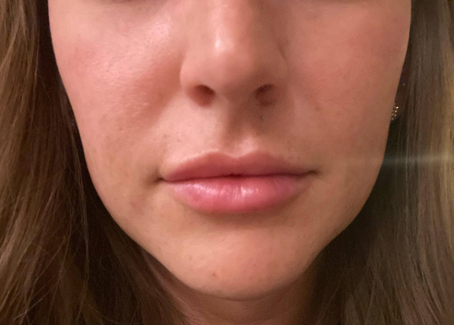 Dermal Fillers before and after results - Nashville patient - after
