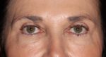 Eyelid Surgery - Case 10313 - After