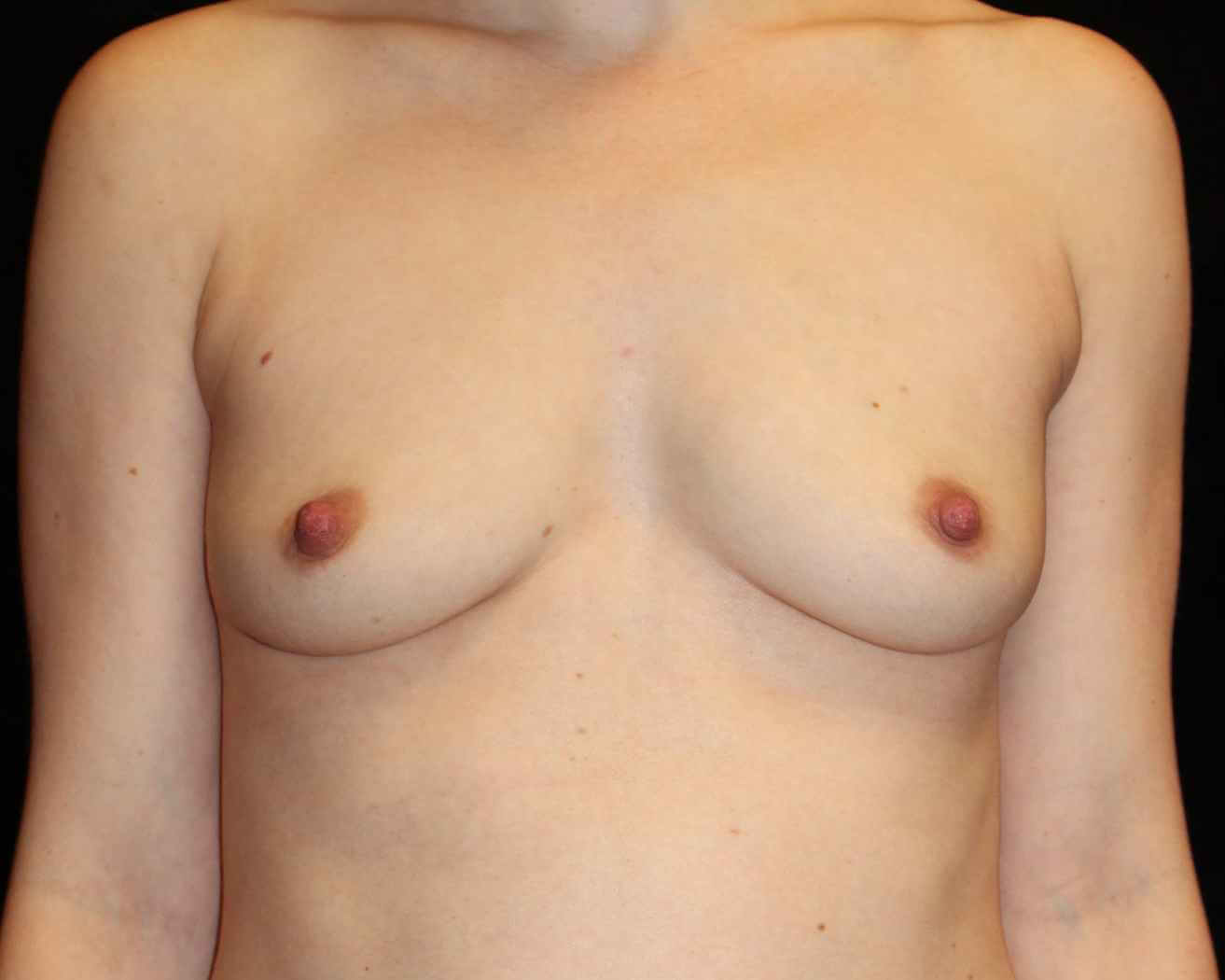 Breast Augmentation Patient Photo - Case 15439 - before view-