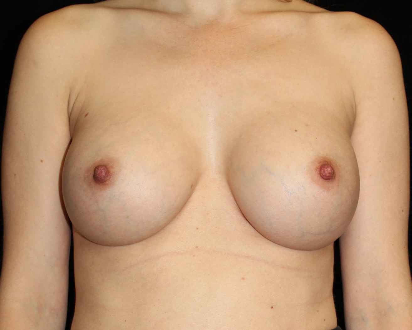 Breast Augmentation Patient Photo - Case 15439 - after view