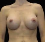 Breast Augmentation - Case 10125 - After