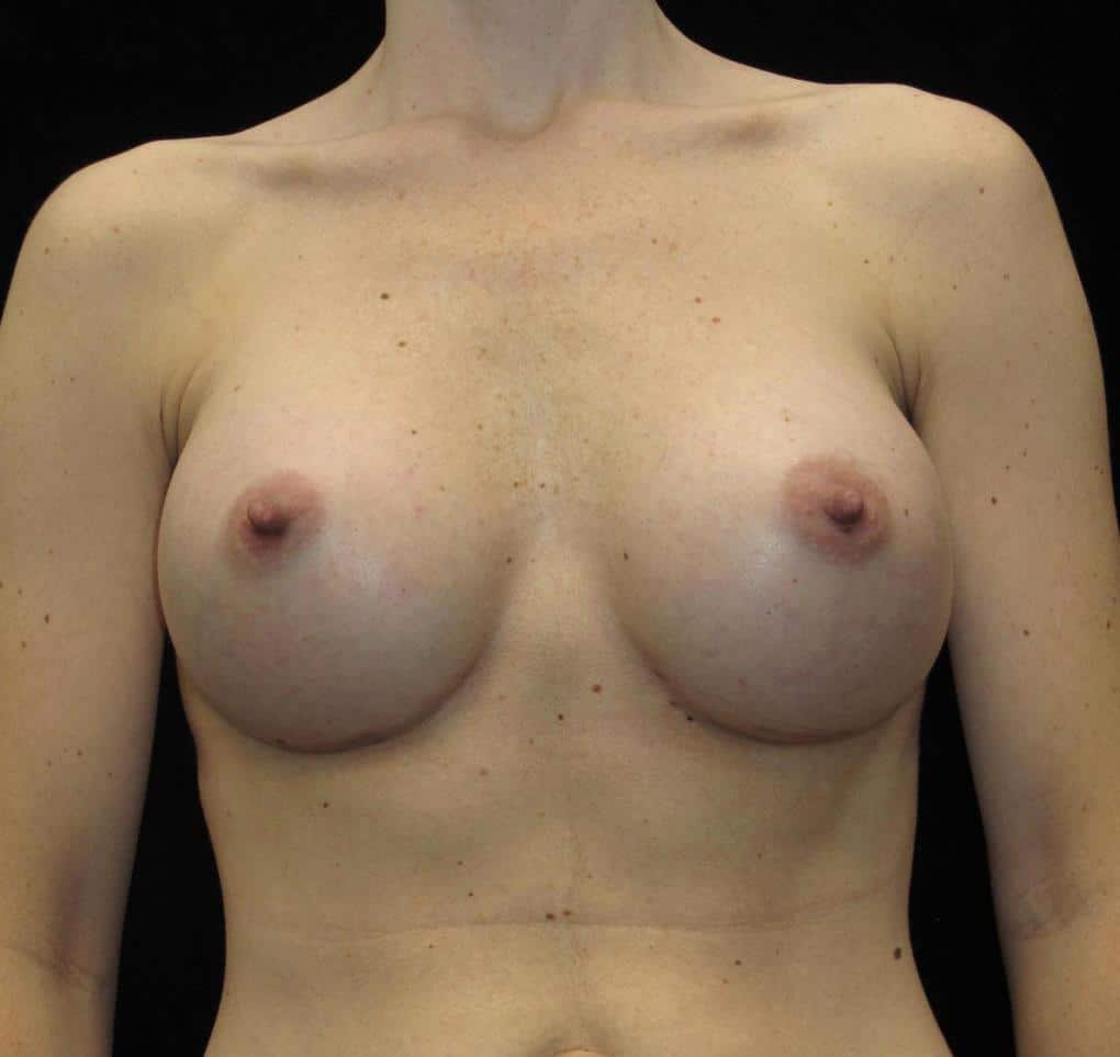 Breast Augmentation Patient Photo - Case 10125 - after view