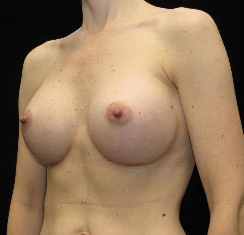 Breast Augmentation Patient Photo - Case 10125 - after view-1