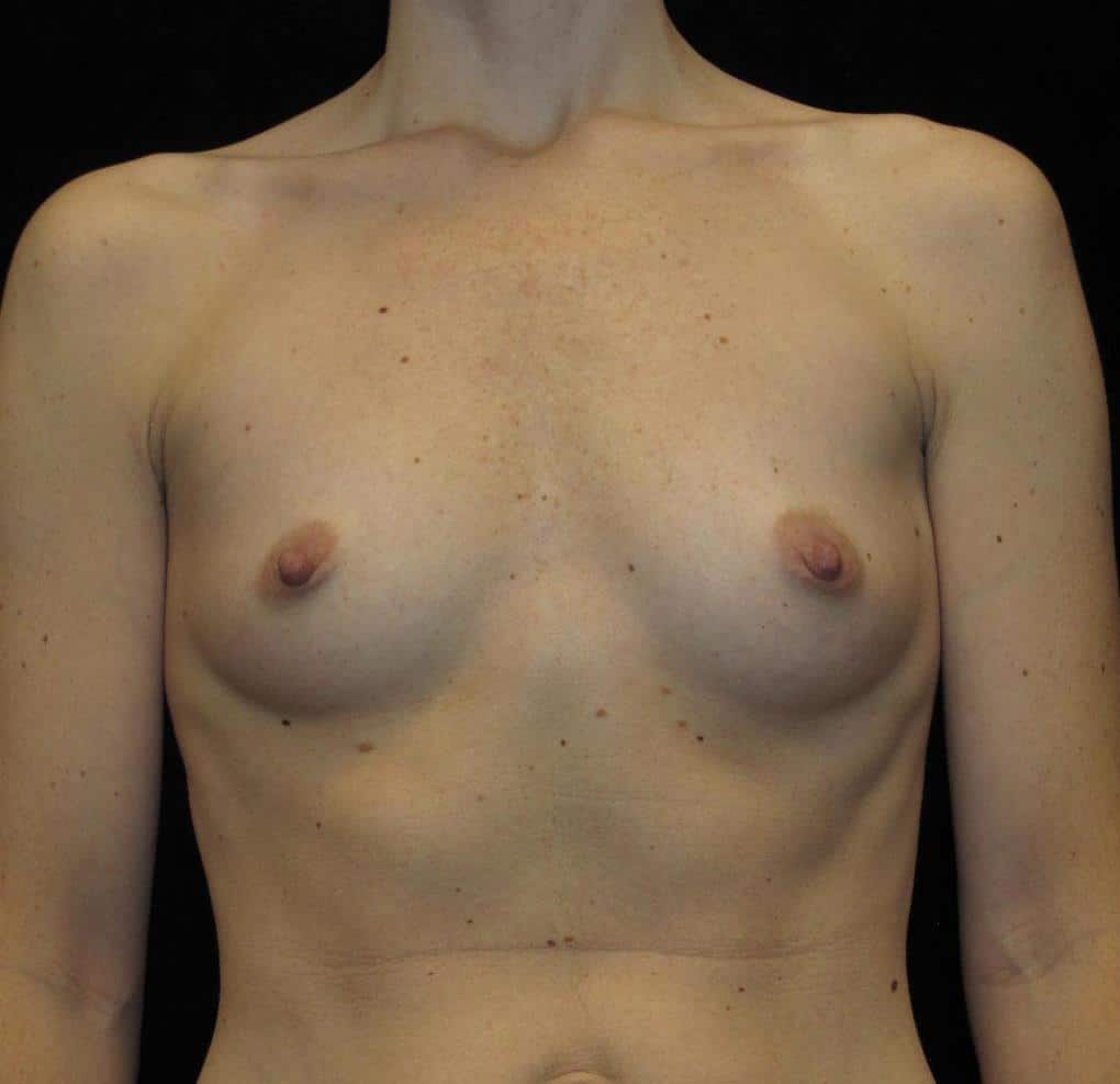 Breast Augmentation Patient Photo - Case 10125 - before view-